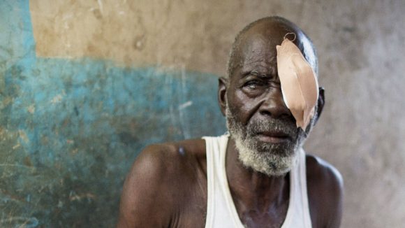Abdul sits in his house after undergoing eye surgery.