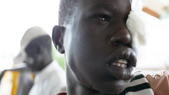 Kuala with one eye bandaged after an operation.