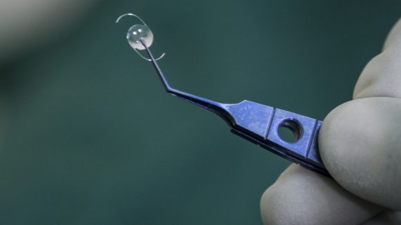 En närbild av plastlinsen som sätts in i ögat under en gråstarroperation.