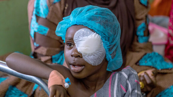 A young girl with a badge on her right eye smiles after receiving cataracts surgery.